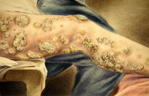 Unspecified skin condition during the Civil War, painted by Hermann Faber.