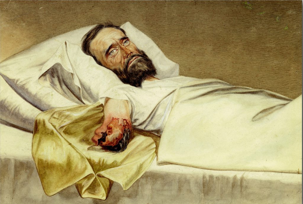 Hospital gangrene suffered by Milton Wallen, Co C, 1st Kentucky Cavalry, when he was in a prison in Richmond. The watercolor by Edward Stauch was lithographed and published in the Medical & Surgical History of the War of the Rebellion, Surgical vol. 2, p. 739. The title, taken from the book, is "Hospital Gangrene of an Arm Stump."